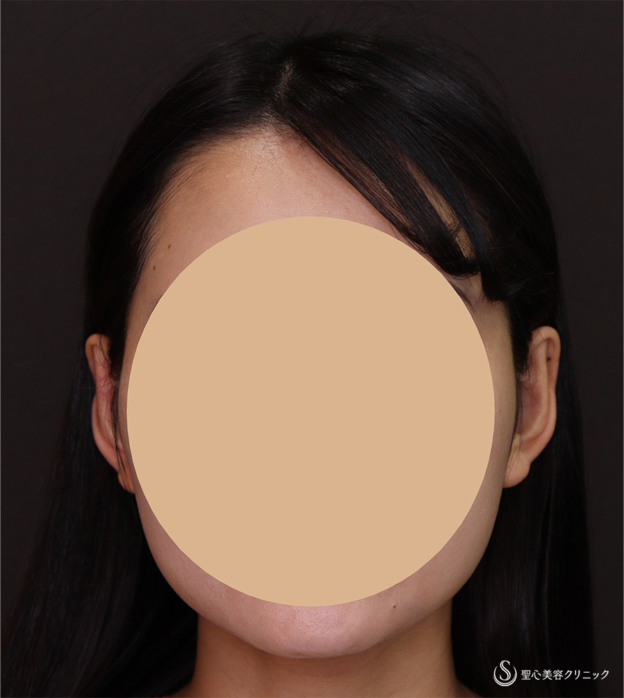 【20代女性・立ち耳】立ち耳修正（埋没法）（3ヶ月後） After 