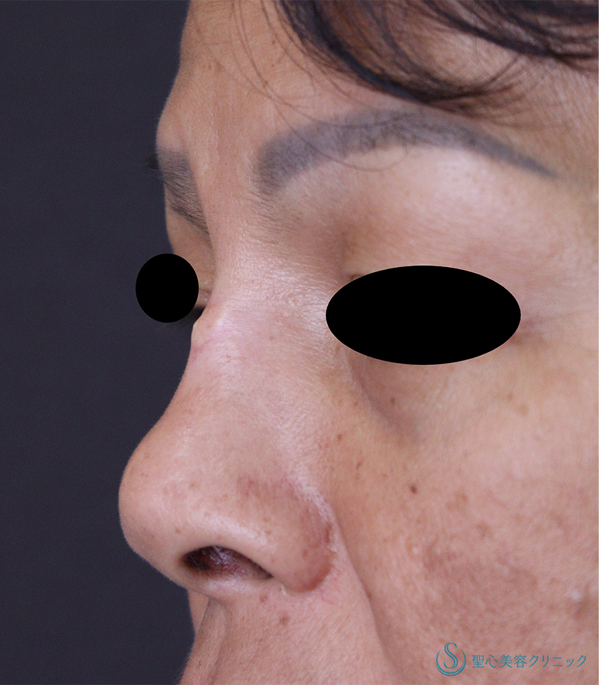 【50代女性・プロテーゼの石灰化】プロテーゼ取り出し・プロテーゼ入替＋石灰化除去（1ヶ月後） Before 