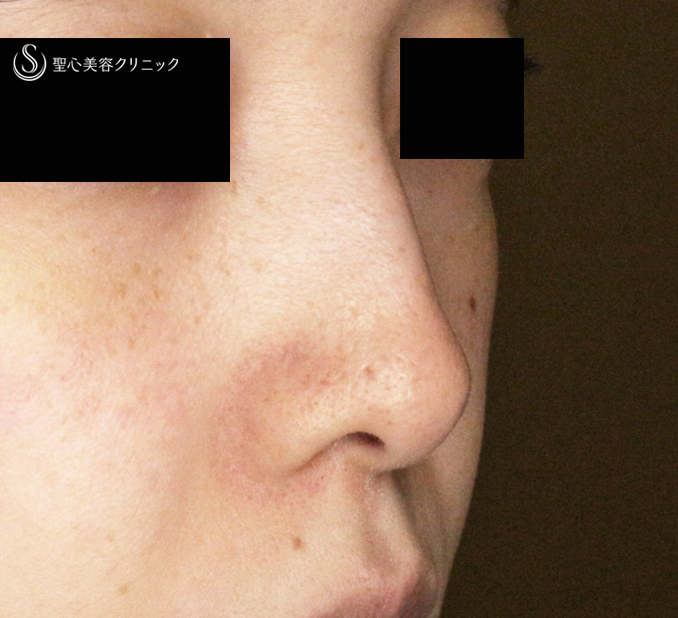 【30代女性・ストラットいらず最新+α法】鼻尖縮小「耳介軟骨移植」+α法（直後〜3ヶ月後） Before 