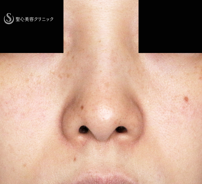 【30代女性・ストラットいらず最新+α法】鼻尖縮小「耳介軟骨移植」+α法（直後〜3ヶ月後） Before 