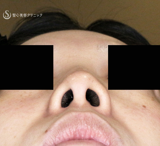 【30代女性・ストラットいらず最新+α法】鼻尖縮小「耳介軟骨移植」+α法（直後〜3ヶ月後） Before 