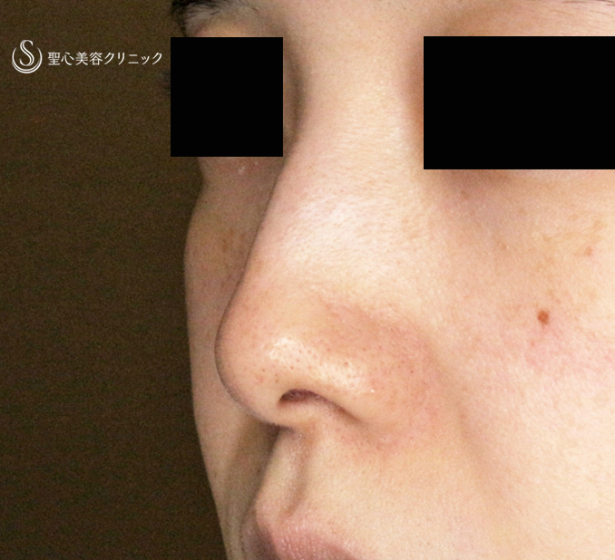 【30代女性・ストラットいらず最新+α法】鼻尖縮小「耳介軟骨移植」+α法（直後〜3ヶ月後） Before 