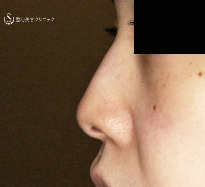 【30代女性・ストラットいらず最新+α法】鼻尖縮小「耳介軟骨移植」+α法（直後〜3ヶ月後） Before 