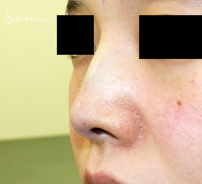 【30代女性・ストラットいらず最新+α法】鼻尖縮小「耳介軟骨移植」+α法（直後〜3ヶ月後） After 