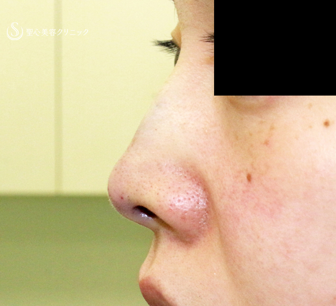【30代女性・ストラットいらず最新+α法】鼻尖縮小「耳介軟骨移植」+α法（直後〜3ヶ月後） Before 