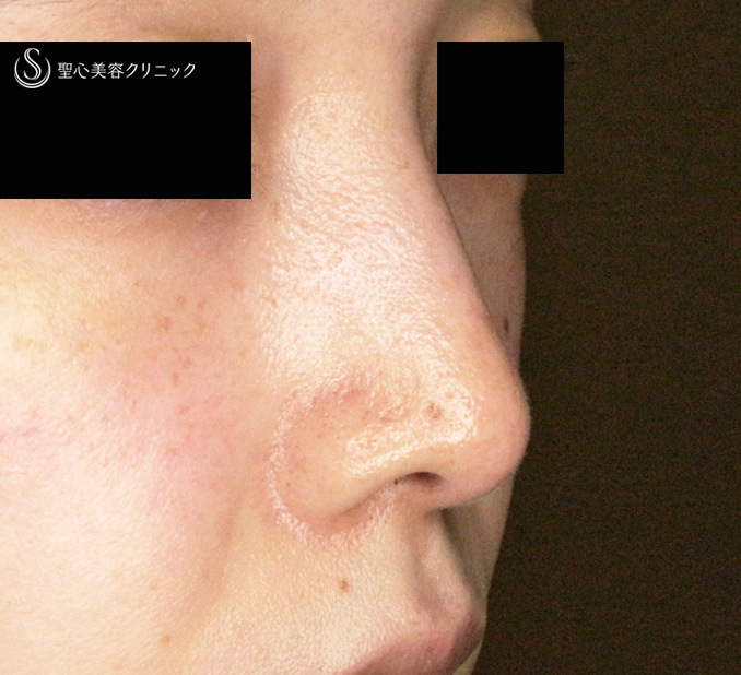 【30代女性・ストラットいらず最新+α法】鼻尖縮小「耳介軟骨移植」+α法（直後〜3ヶ月後） After 