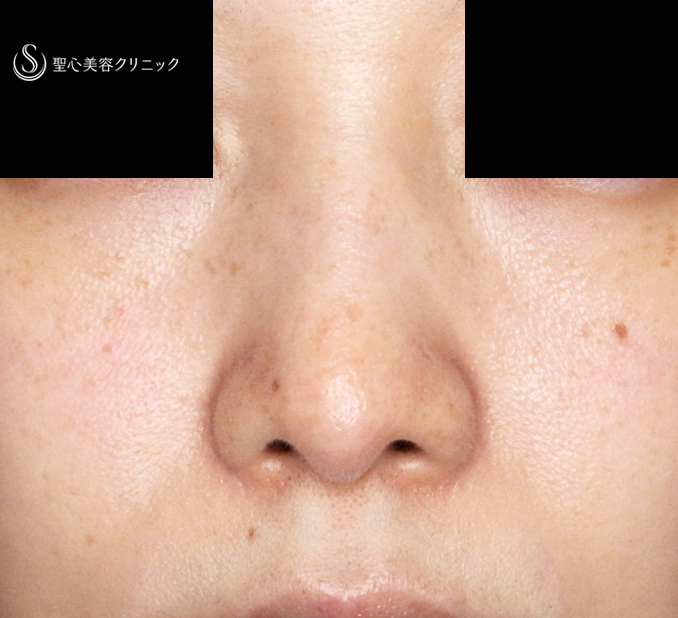 【30代女性・ストラットいらず最新+α法】鼻尖縮小「耳介軟骨移植」+α法（直後〜3ヶ月後） After 