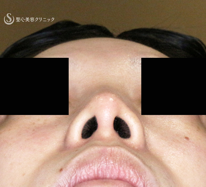 【30代女性・ストラットいらず最新+α法】鼻尖縮小「耳介軟骨移植」+α法（直後〜3ヶ月後） After 