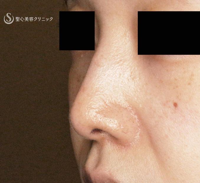 【30代女性・ストラットいらず最新+α法】鼻尖縮小「耳介軟骨移植」+α法（直後〜3ヶ月後） After 