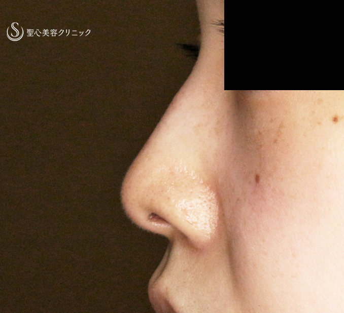 【30代女性・ストラットいらず最新+α法】鼻尖縮小「耳介軟骨移植」+α法（直後〜3ヶ月後） After 