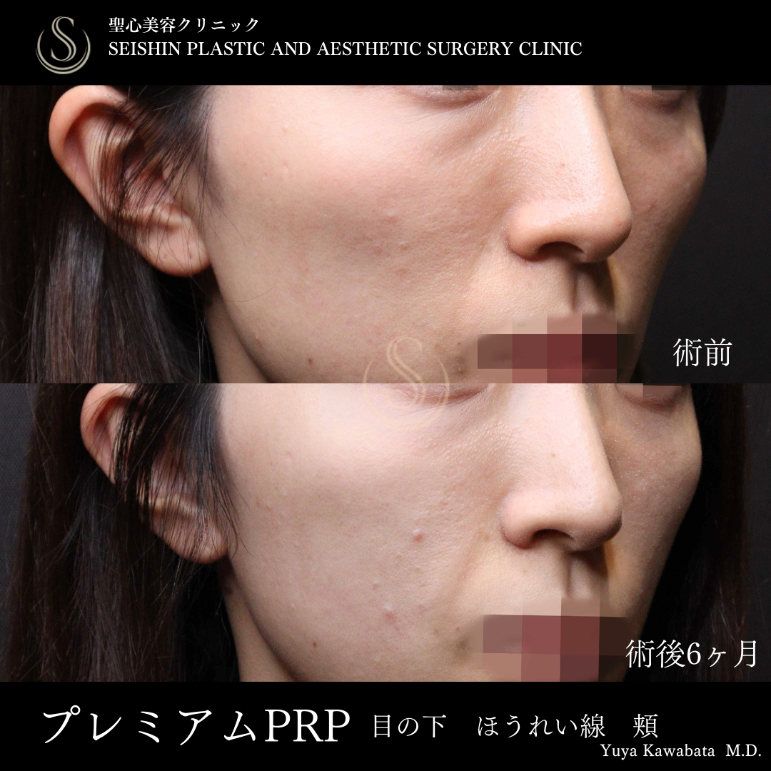 【20代女性・プレミアムPRPで若々しくハリのあるお顔に】プレミアムPRP皮膚再生療法（術後6ヶ月） Before 