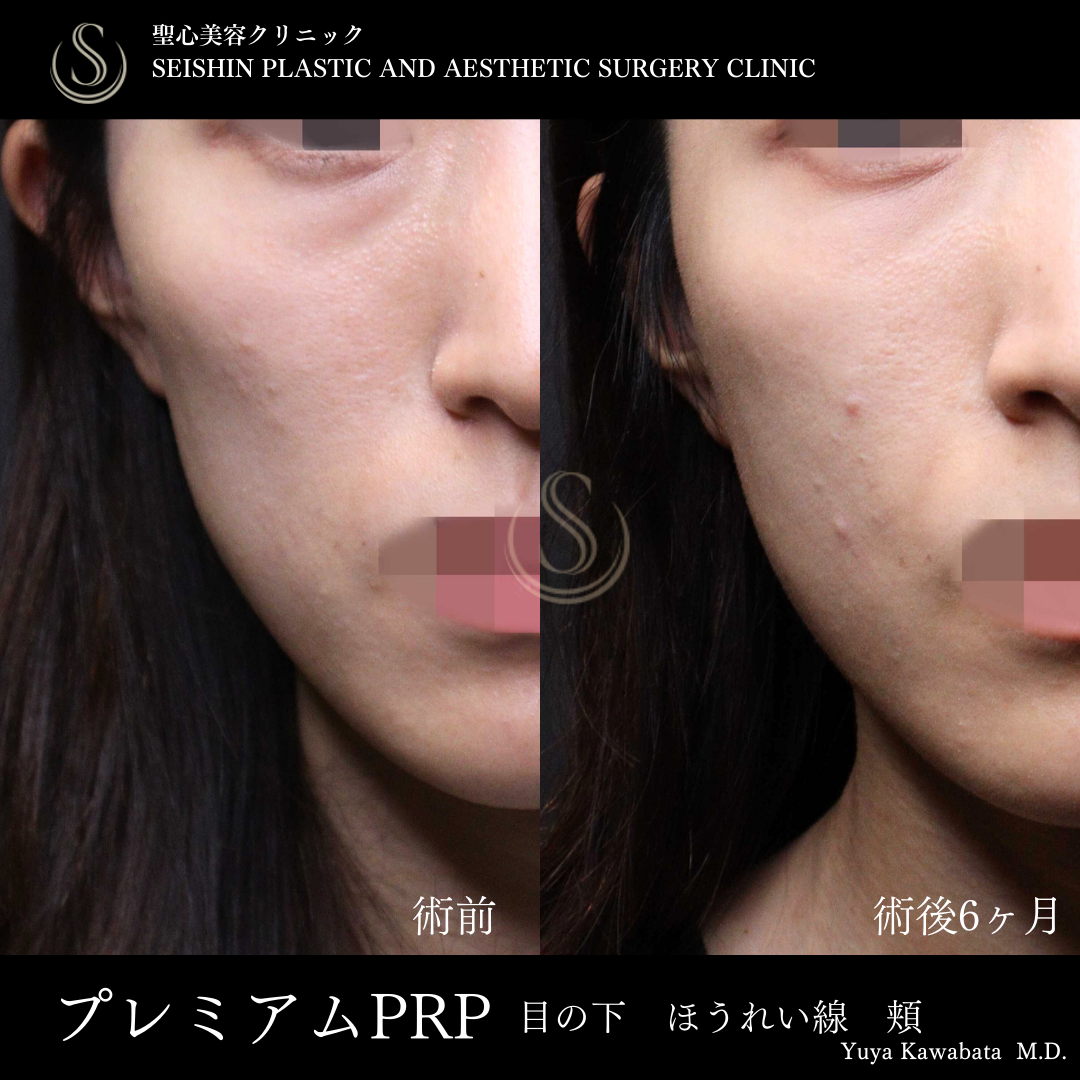 【20代女性・プレミアムPRPで若々しくハリのあるお顔に】プレミアムPRP皮膚再生療法（術後6ヶ月） After 