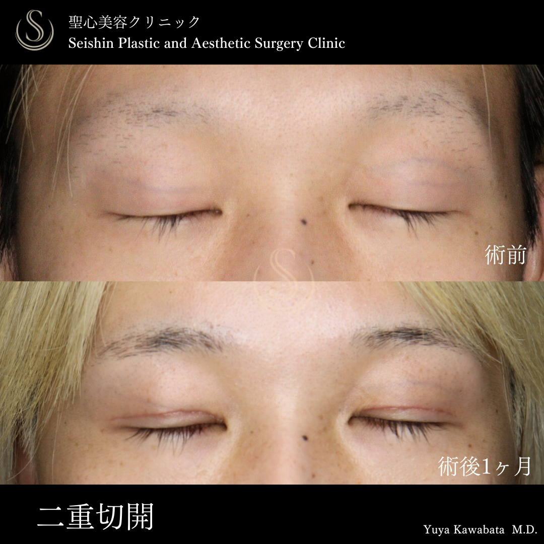 【20代男性・二重切開でスッキリ瞼に】二重術（切開法）部分切開/全切開（術後1ヶ月） After 