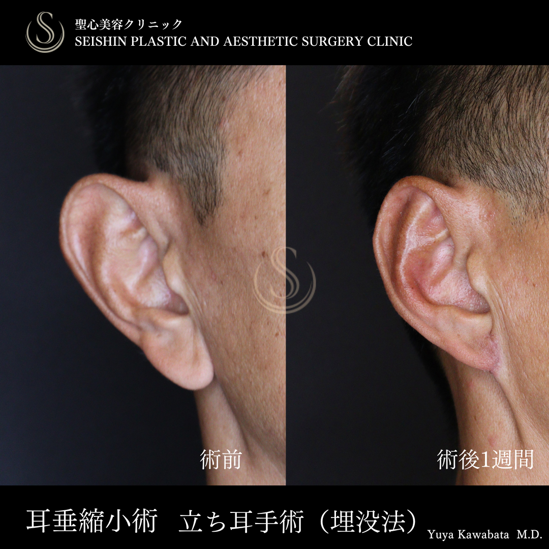 【50代男性・耳たぶ縮小と埋没耳手術で忘れ耳に】耳たぶ修正＋立ち耳修正（埋没法）（術後1週間） Before 