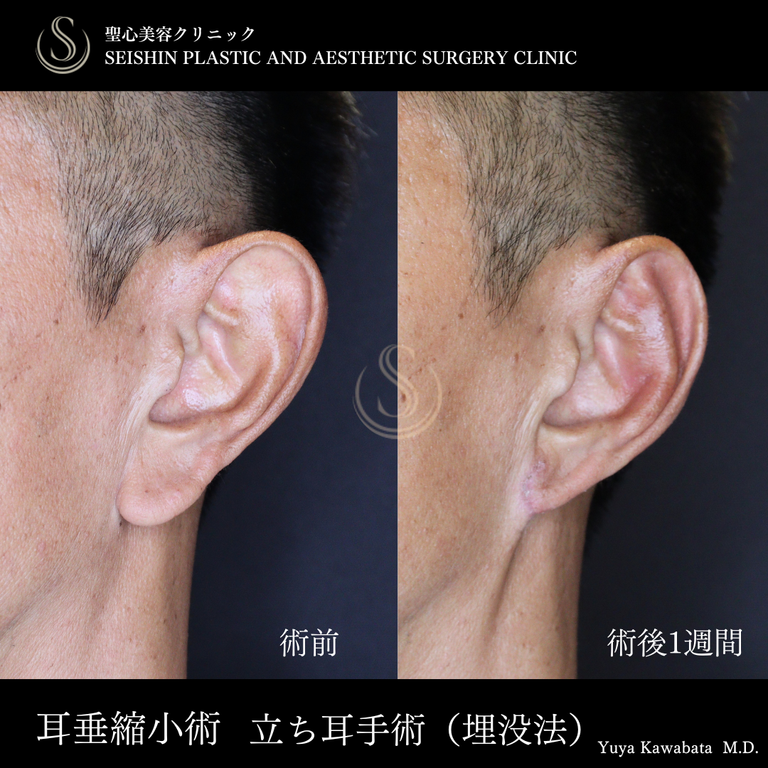 【50代男性・耳たぶ縮小と埋没耳手術で忘れ耳に】耳たぶ修正＋立ち耳修正（埋没法）（術後1週間） After 
