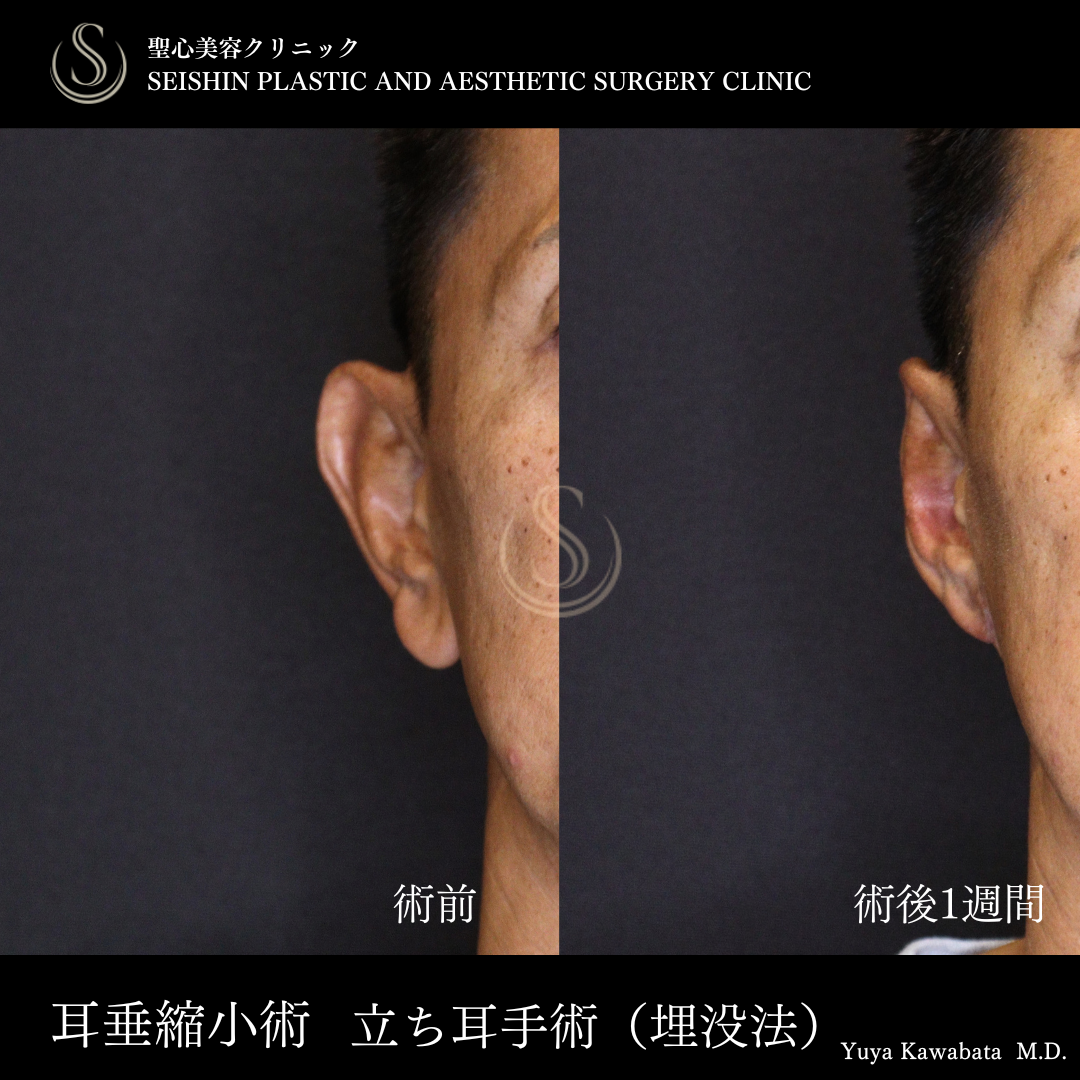 【50代男性・耳たぶ縮小と埋没耳手術で忘れ耳に】耳たぶ修正＋立ち耳修正（埋没法）（術後1週間） After 