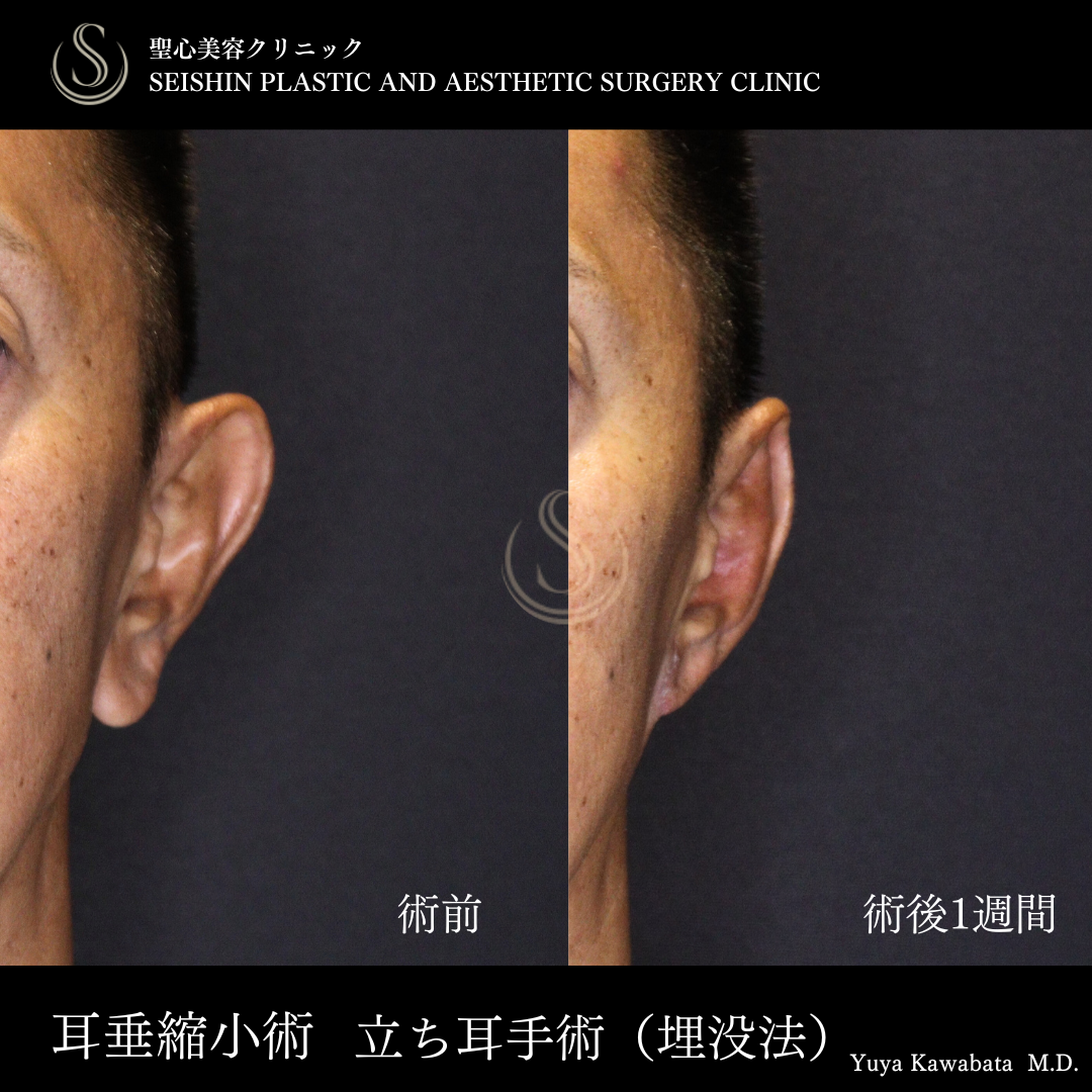 【50代男性・耳たぶ縮小と埋没耳手術で忘れ耳に】耳たぶ修正＋立ち耳修正（埋没法）（術後1週間） After 