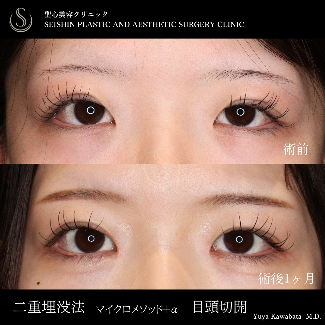 【20代女性・二重ラインの調整と目頭切開で自然に華やかなお目元に】二重術（埋没法）マイクロメソッド+α＋目頭切開（術後1ヶ月） Before 