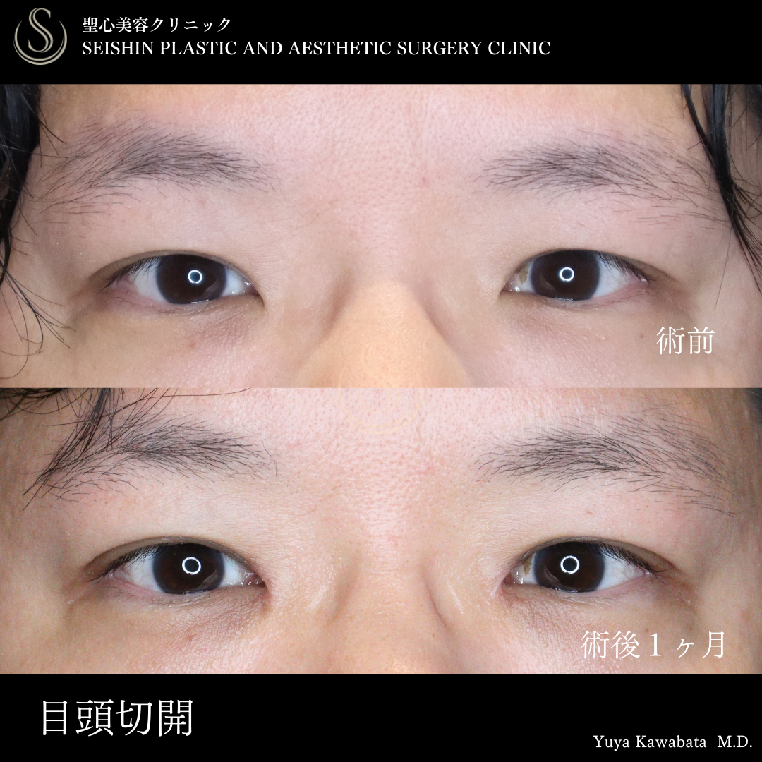 【40代男性・目頭切開で自然に目を拡大】目頭切開/目上切開（術後1ヶ月） Before 