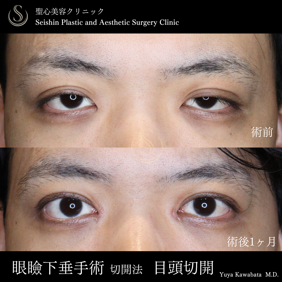【20代男性・眼瞼下垂と目頭切開で自然に目の開きをアップ】眼瞼下垂（切開法/腱膜縫縮法）＋目頭切開/目上切開（術直後～術後1ヶ月） Before 