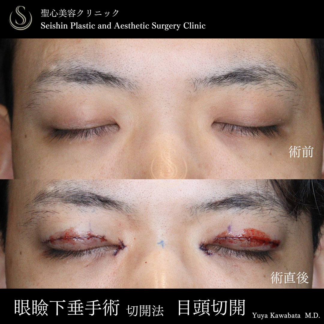 【20代男性・眼瞼下垂と目頭切開で自然に目の開きをアップ】眼瞼下垂（切開法/腱膜縫縮法）＋目頭切開/目上切開（術直後～術後1ヶ月） After 