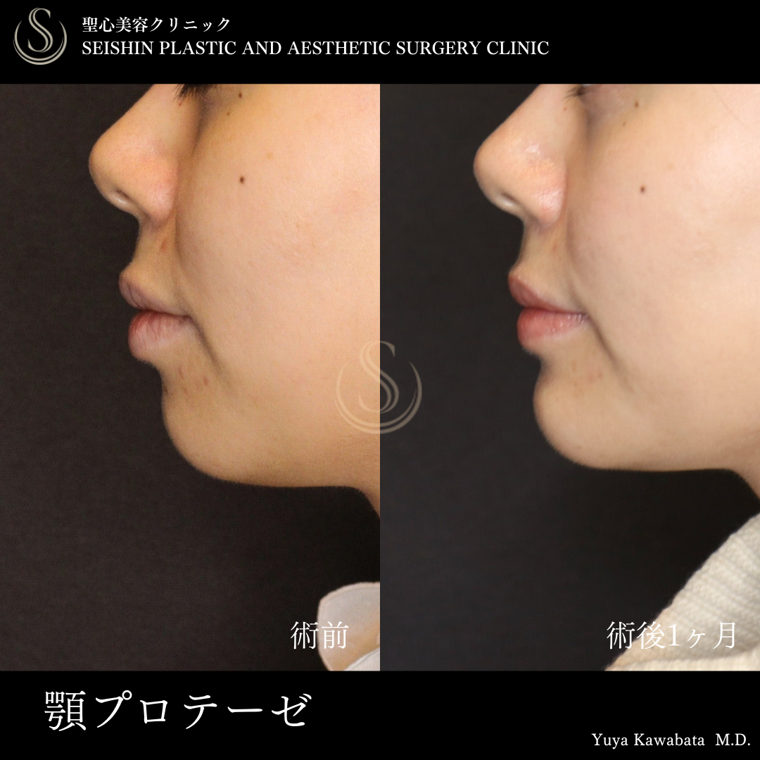 【30代女性・顎プロテーゼでEラインを整える】あごプロテーゼ（術後1ヶ月） Before 