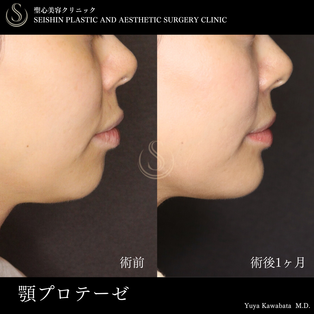 【30代女性・顎プロテーゼでEラインを整える】あごプロテーゼ（術後1ヶ月） After 