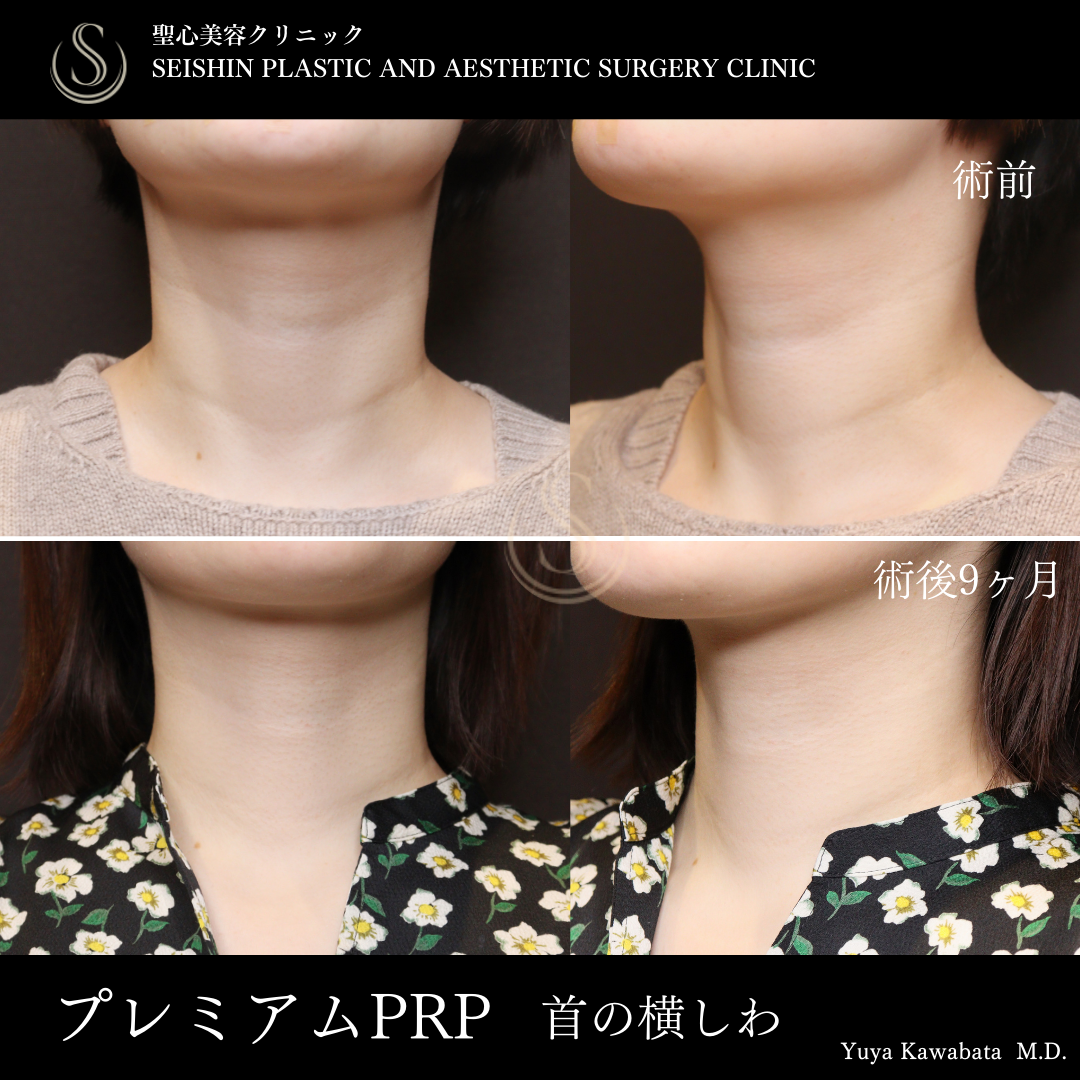 【30代女性・首の横シワをPRPで改善】プレミアムPRP皮膚再生療法（術後9ヶ月） Before 