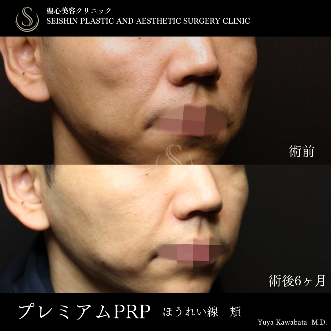 【40代男性・プレミアムPRPで頬コケを自然に改善】プレミアムPRP皮膚再生療法（術後6ヶ月） After 