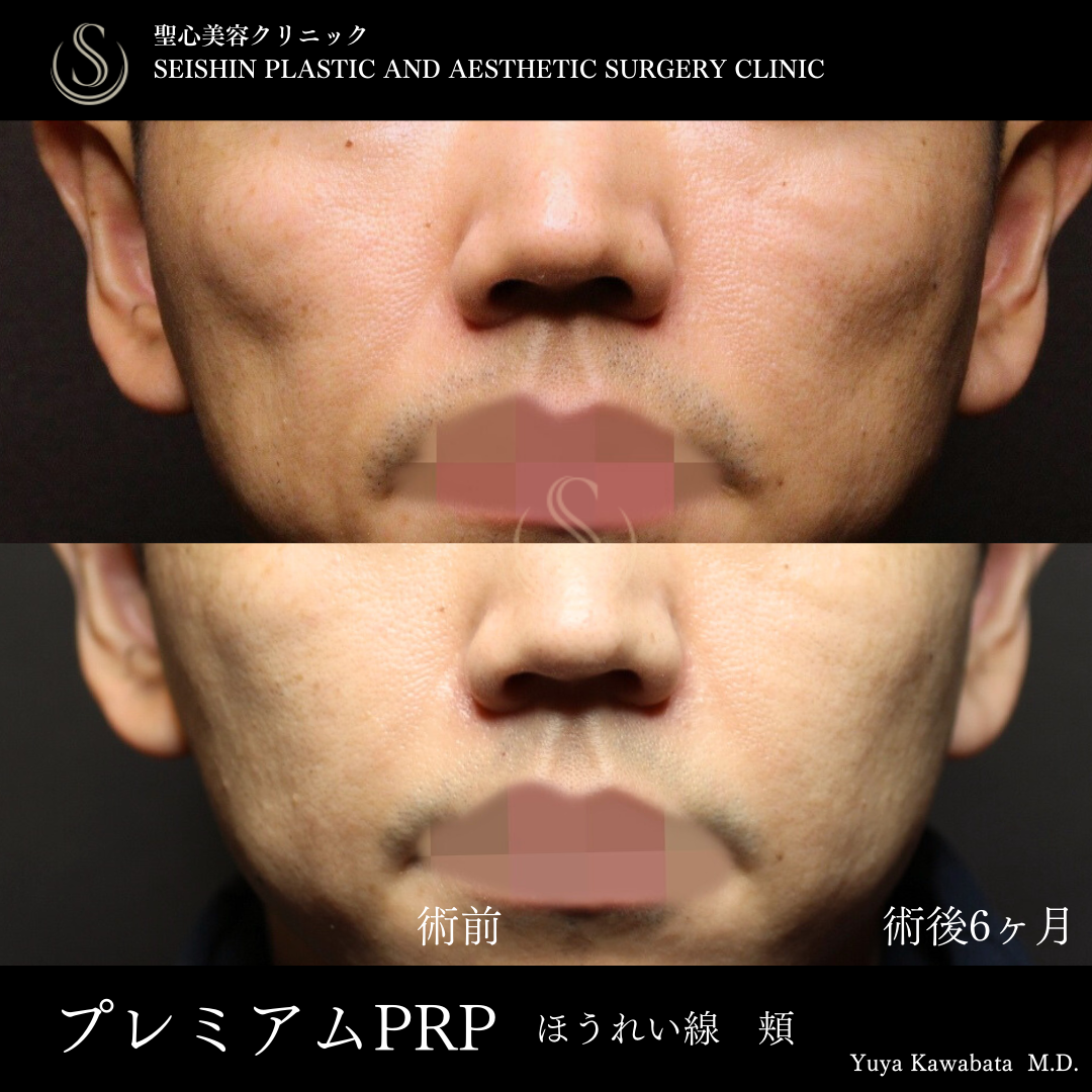 【40代男性・プレミアムPRPで頬コケを自然に改善】プレミアムPRP皮膚再生療法（術後6ヶ月） Before 