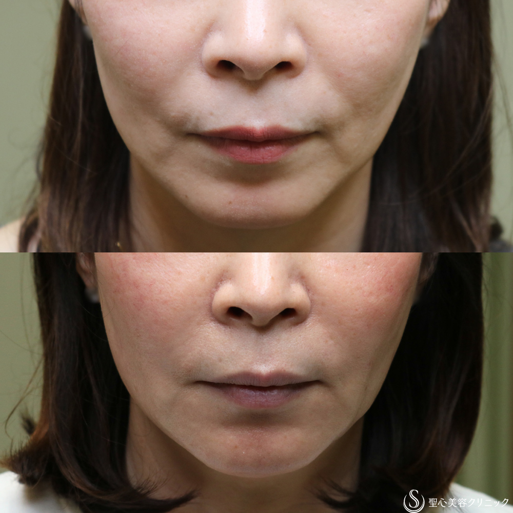 【50代女性・ほうれい線、マリオネットラインの若返り】プレミアムPRP皮膚再生療法（1年8ヶ月後） After 