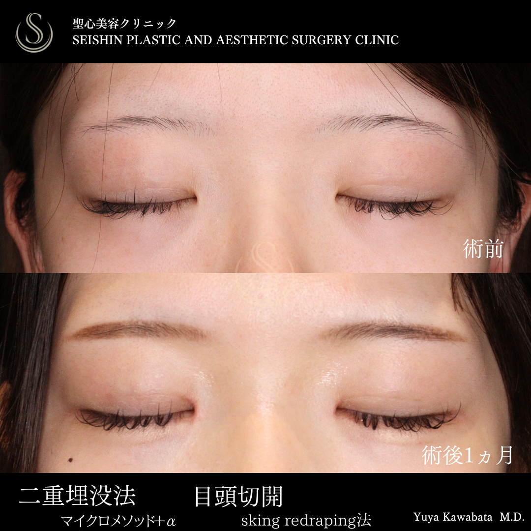 【20代女性・二重ラインの調整と目頭切開で自然に華やかなお目元に】二重術（埋没法）マイクロメソッド+α＋目頭切開（術後1ヶ月） After 