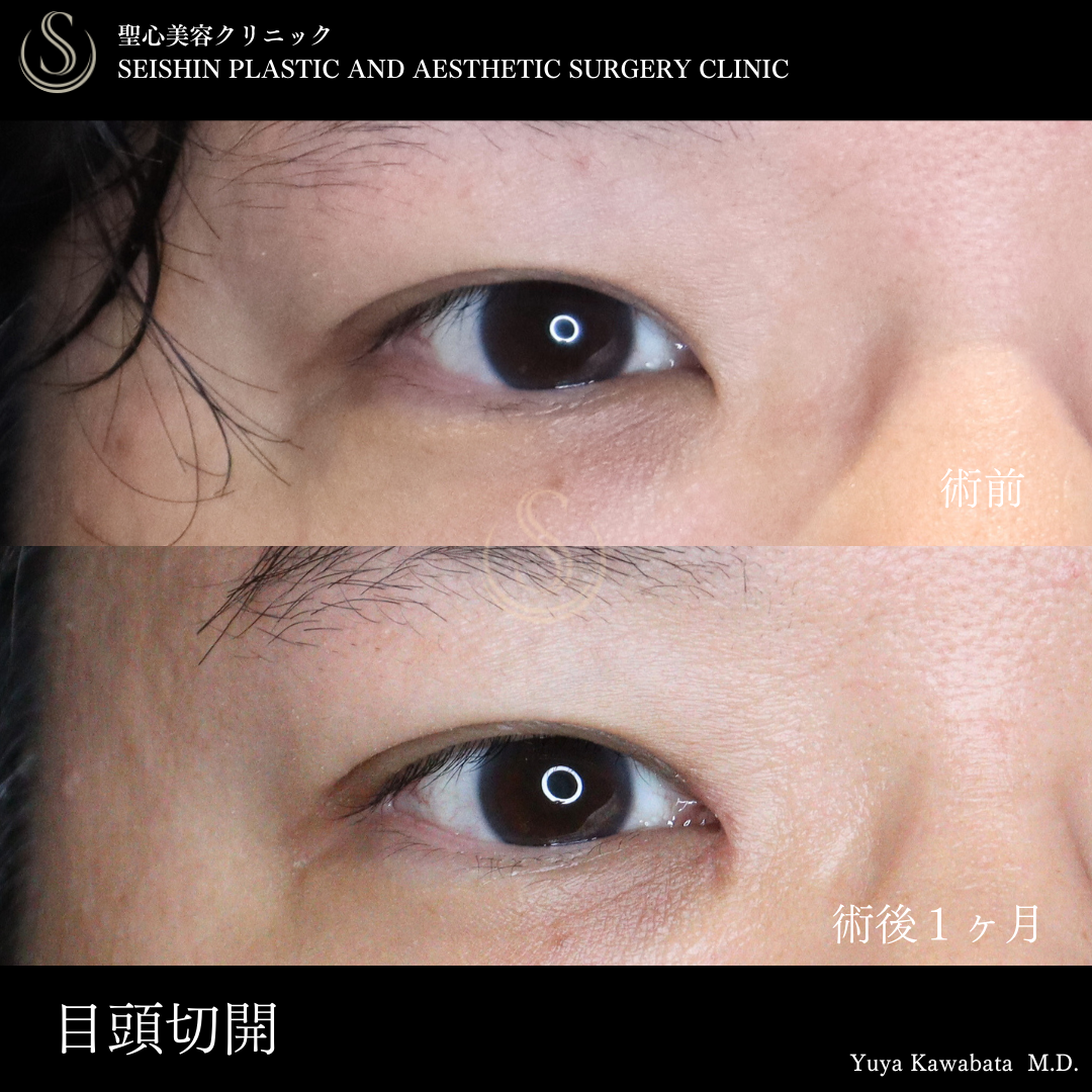 【40代男性・目頭切開で自然に目を拡大】目頭切開/目上切開（術後1ヶ月） After 