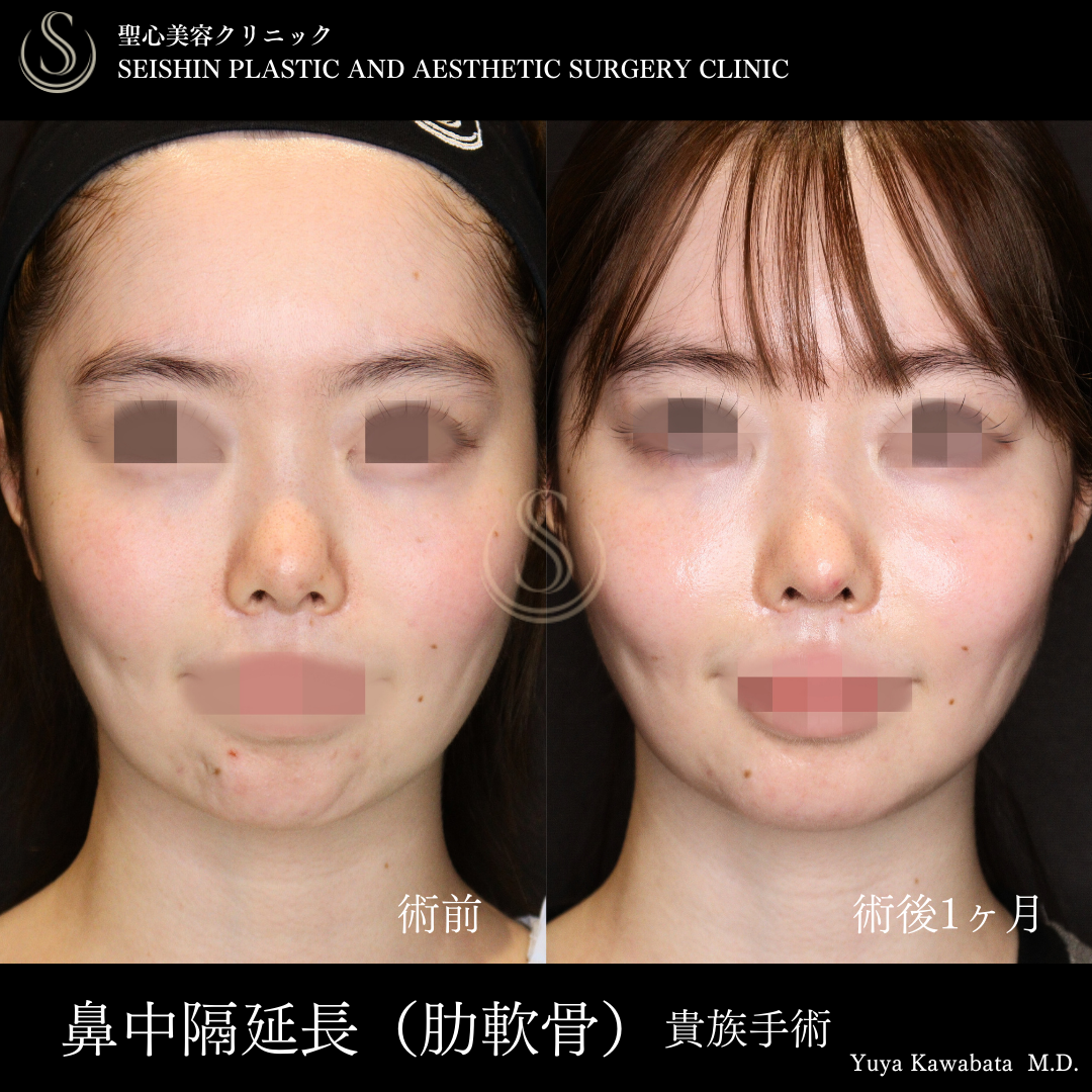 【20代女性・鼻中隔延長で自然な鼻筋に】鼻中隔延長術（肋軟骨）＋鼻尖形成（術後1ヶ月）＋貴族手術（術後1ヶ月） After 