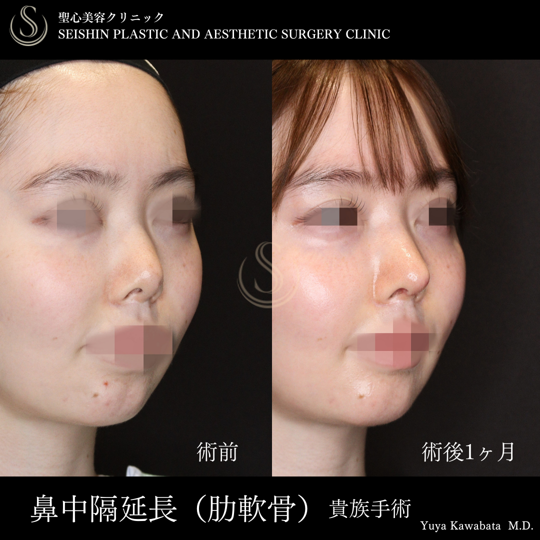 【20代女性・鼻中隔延長で自然な鼻筋に】鼻中隔延長術（肋軟骨）＋鼻尖形成（術後1ヶ月）＋貴族手術（術後1ヶ月） After 
