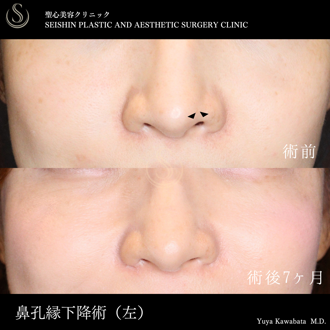 【30代女性・鼻孔縁下降術で鼻の左右差をととのえる】鼻孔縁下降術（術後7ヶ月） After 