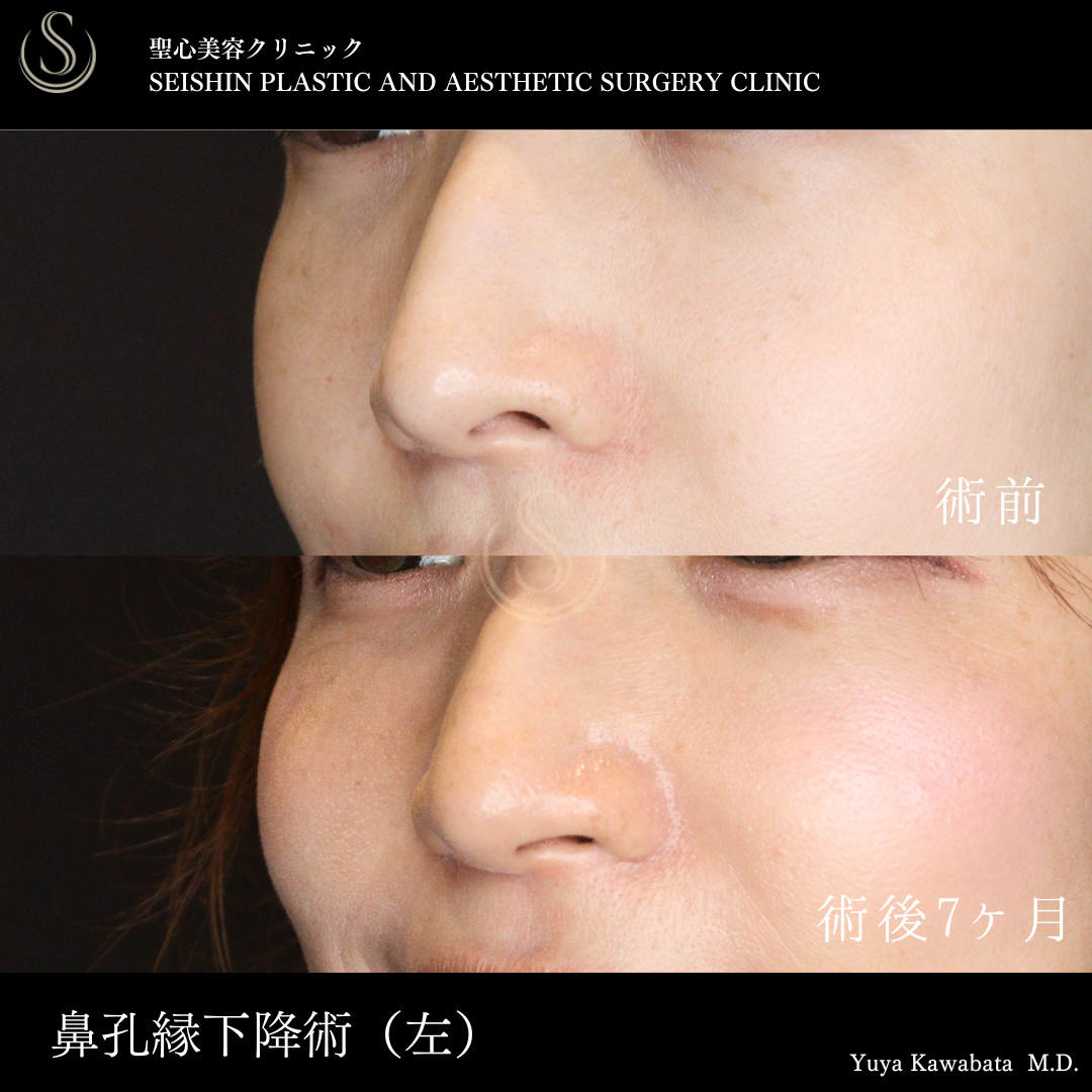 【30代女性・鼻孔縁下降術で鼻の左右差をととのえる】鼻孔縁下降術（術後7ヶ月） Before 
