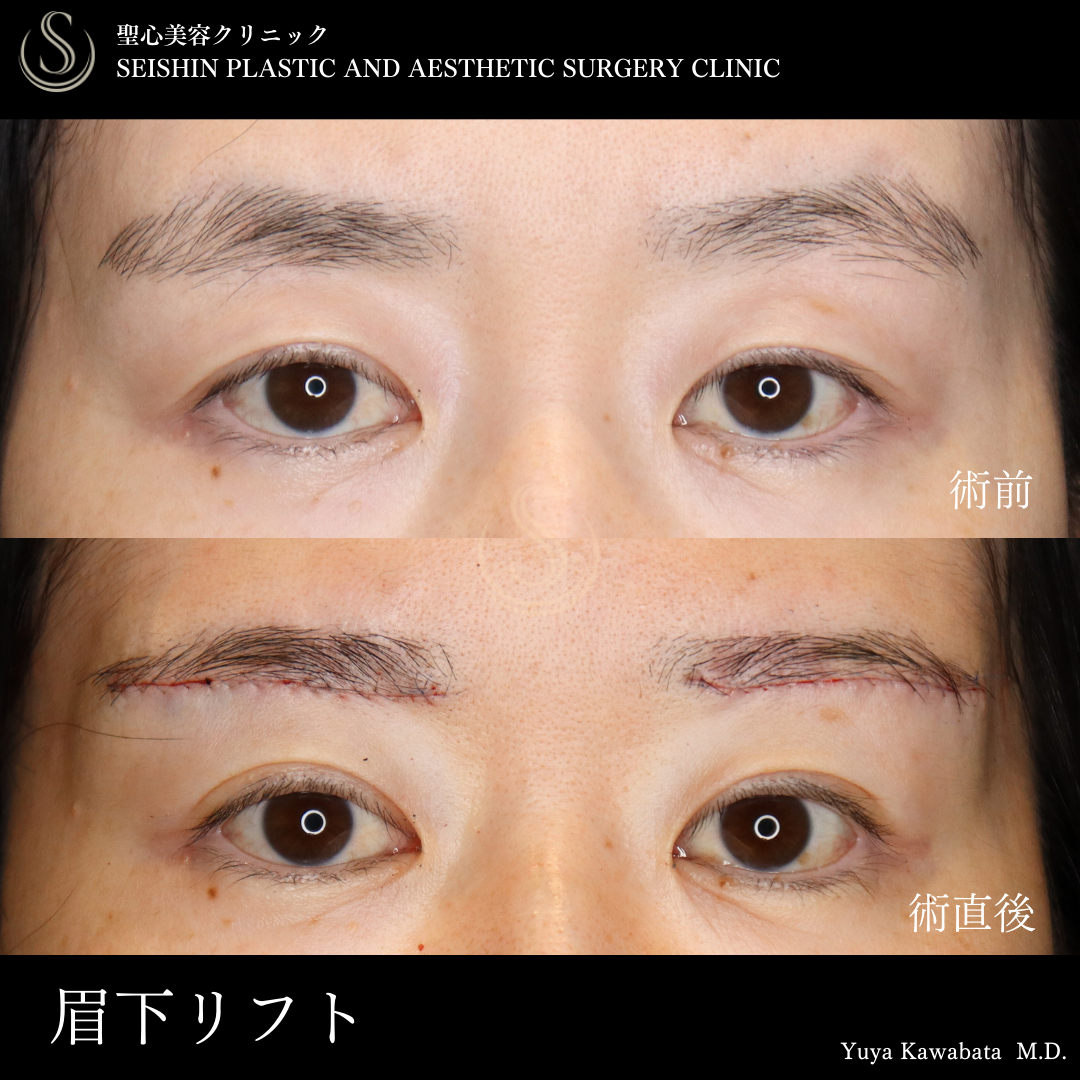 【40代女性・眉下リフトで魅力的なお目元に】眉下切開法（眉下リフト）（術後1ヶ月） After 
