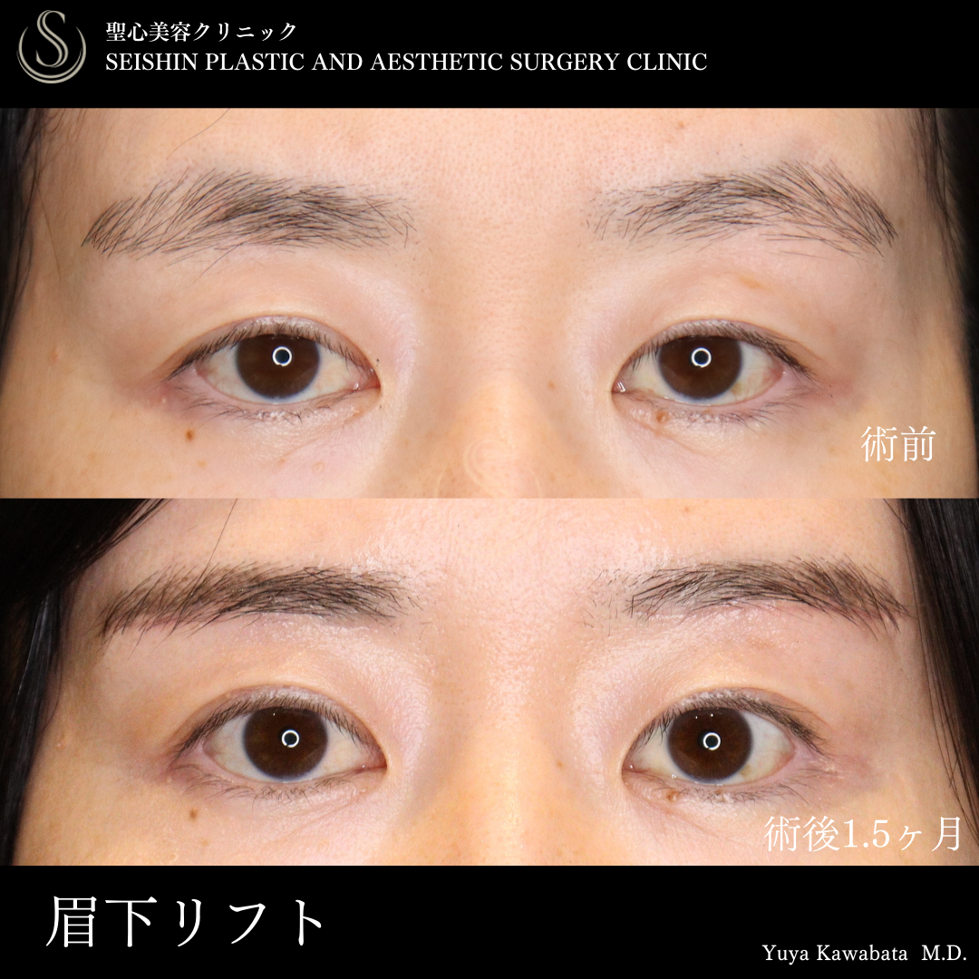 【40代女性・眉下リフトで魅力的なお目元に】眉下切開法（眉下リフト）（術後1ヶ月） Before 