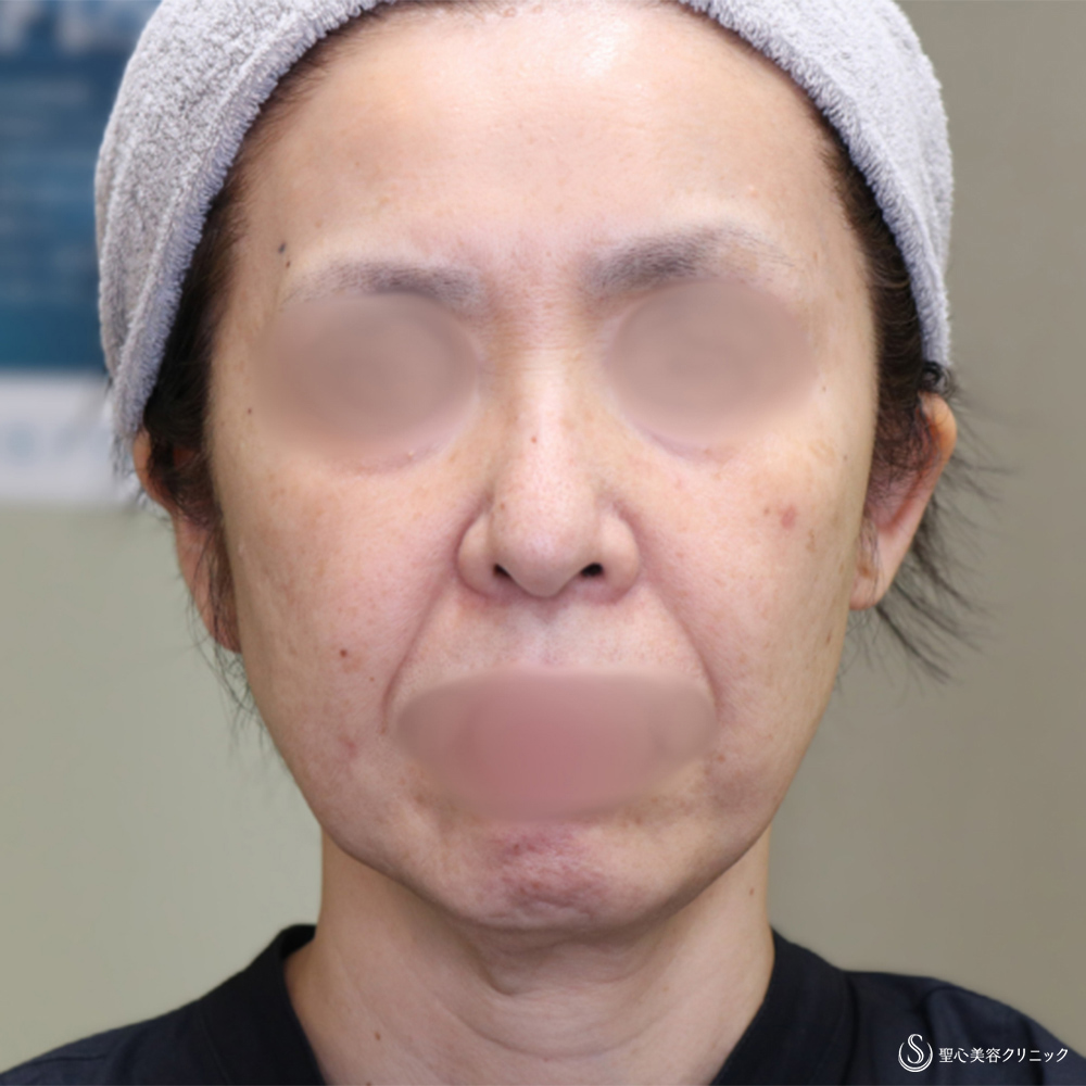 【50代女性・フェイスラインをスッキリ】フェイスリフト+脂肪吸引(頬・顎下)(術後1ヶ月) Before 