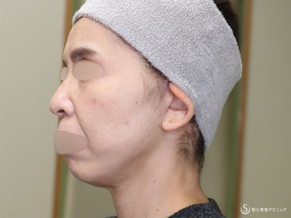 【50代女性・フェイスラインをスッキリ】フェイスリフト+脂肪吸引(頬・顎下)(術後1ヶ月) After 