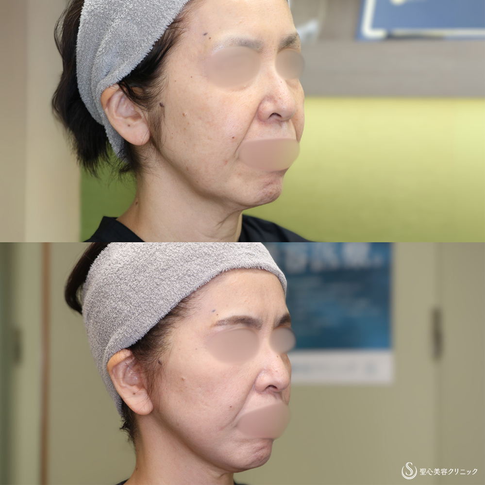 【50代女性・フェイスラインをスッキリ】フェイスリフト+脂肪吸引(頬・顎下)(術後1ヶ月) After 