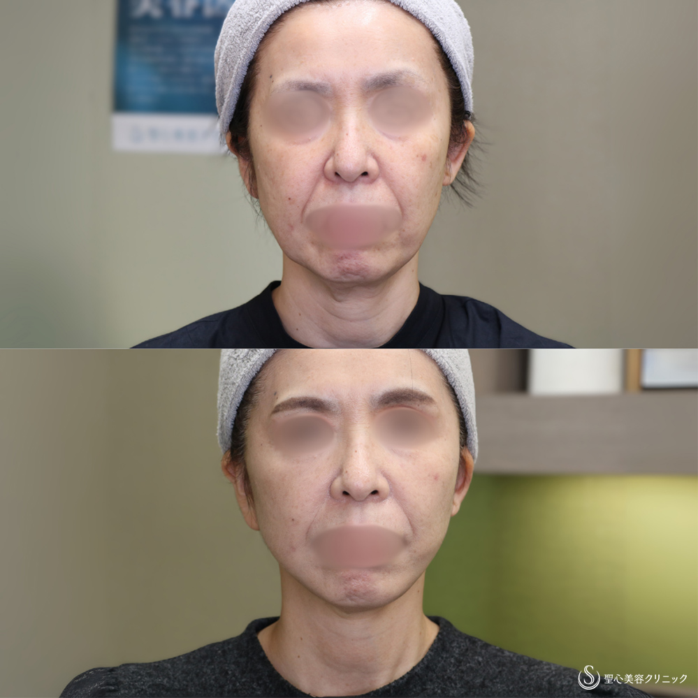 【50代女性・フェイスラインをスッキリ】フェイスリフト+脂肪吸引(頬・顎下)(術後1ヶ月) After 
