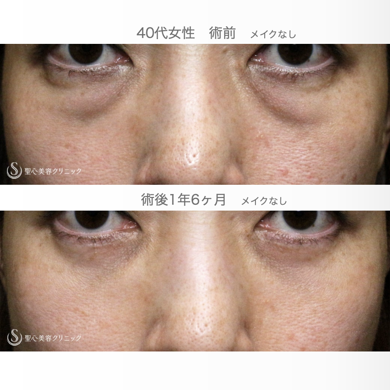 【40代女性・私が裏ハムラをしない理由】表ハムラ+α法「Ver.2.5」単独例（1年6ヶ月後） After 
