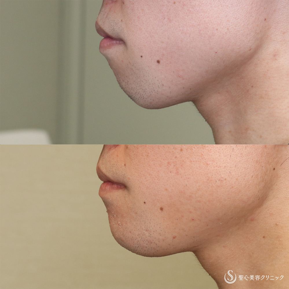 【20代男性・Eラインを整える】あごプロテーゼ（術後3ヶ月） After 