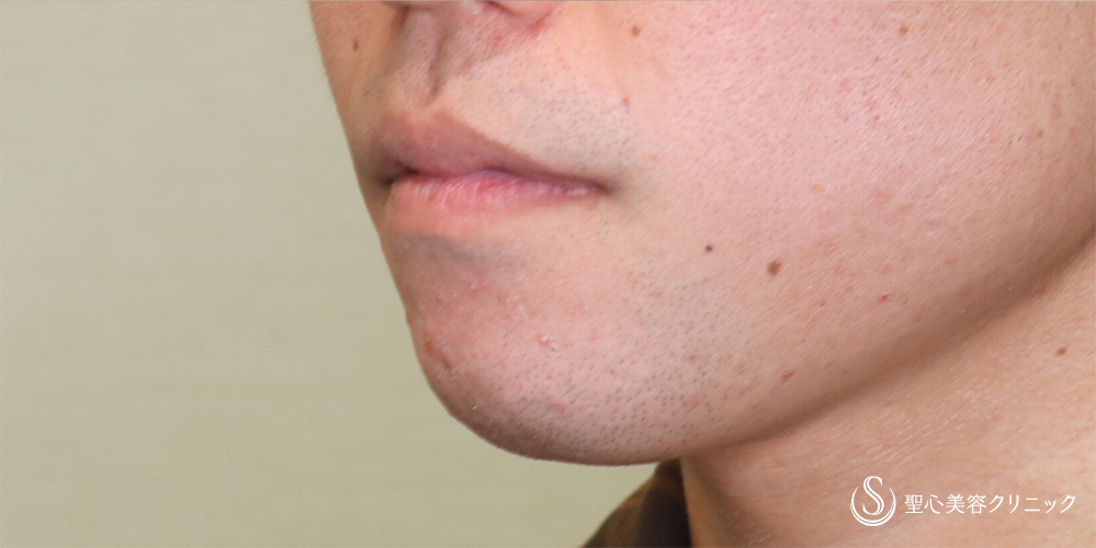 【20代男性・Eラインを整える】あごプロテーゼ（術後3ヶ月） After 