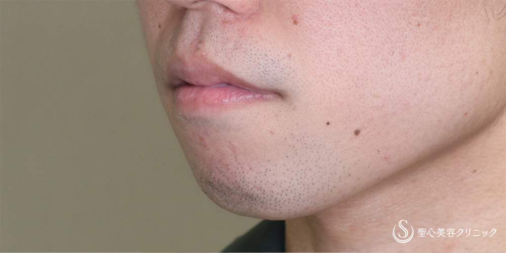 【20代男性・Eラインを整える】あごプロテーゼ（術後3ヶ月） Before 
