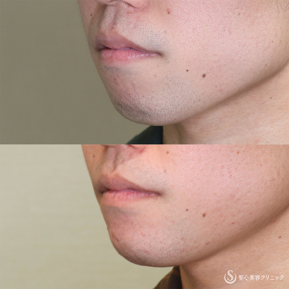 【20代男性・Eラインを整える】あごプロテーゼ（術後3ヶ月） After 