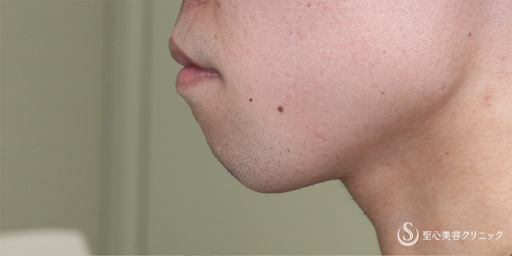 【20代男性・Eラインを整える】あごプロテーゼ（術後3ヶ月） Before 