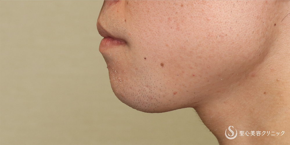 【20代男性・Eラインを整える】あごプロテーゼ（術後3ヶ月） After 